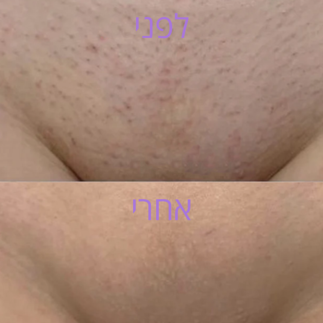 VelvetaSkin™ - מכשיר להסרת שיער