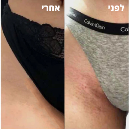 VelvetaSkin™ - מכשיר להסרת שיער