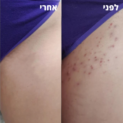 VelvetaSkin™ - מכשיר להסרת שיער.