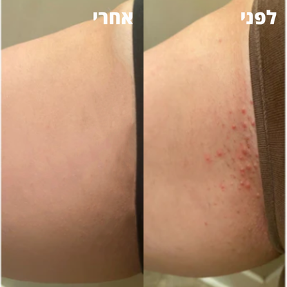 VelvetaSkin™ - מכשיר להסרת שיער.