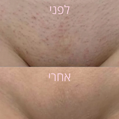 VelvetaSkin™ - מכשיר להסרת שיער