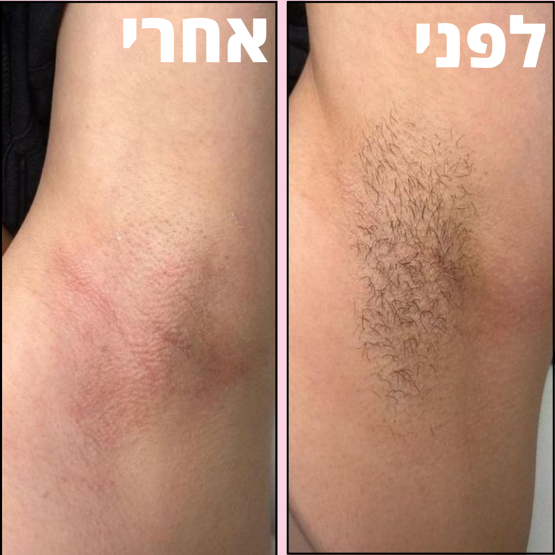 VelvetaSkin™ - מכשיר להסרת שיער