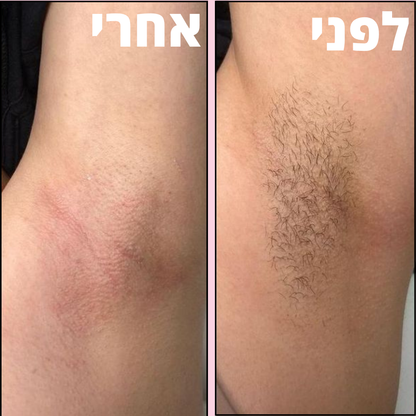 VelvetaSkin™ - מכשיר להסרת שיער