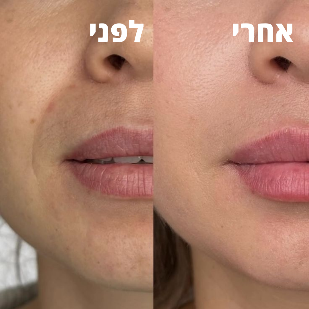 VelvetaFace™ - מכשיר להסרת שיער בפנים