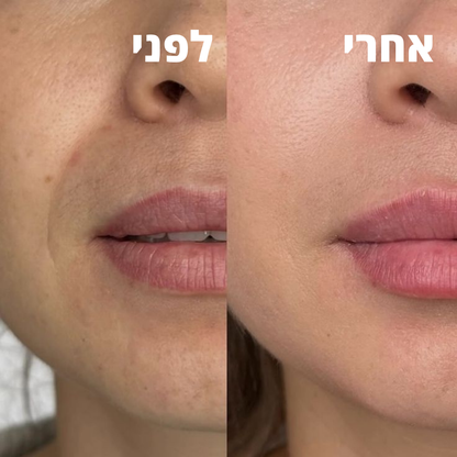 VelvetaFace™ - מכשיר להסרת שיער בפנים