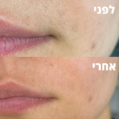 VelvetaFace™ - מכשיר להסרת שיער בפנים
