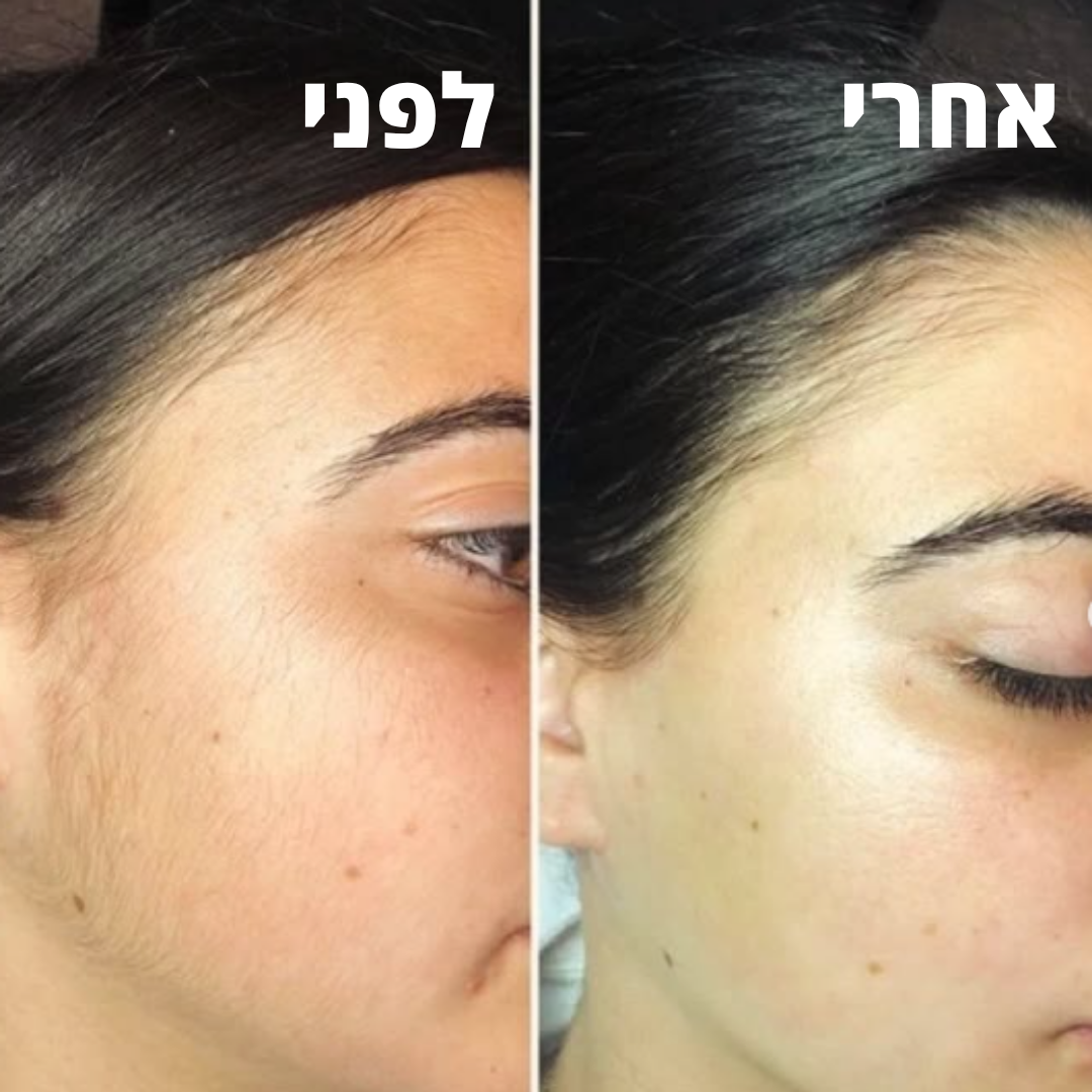 VelvetaFace™ - מכשיר להסרת שיער בפנים