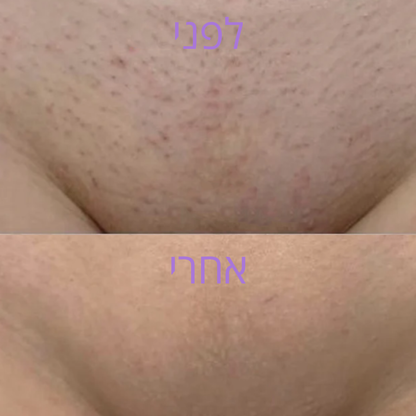 VelvetaSkin™ - מכשיר להסרת שיער.